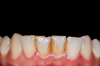 Teeth with coffee staining before cleaning