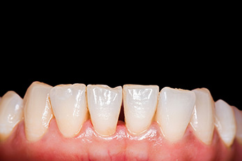 Clean teeth after stain removal