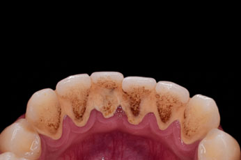 Teeth with smoking stains before cleaning