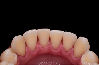 Clean teeth after smoking stain removal