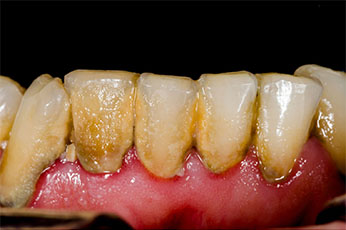 Teeth with tartar buildup before cleaning