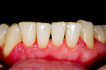 Clean teeth after tartar removal